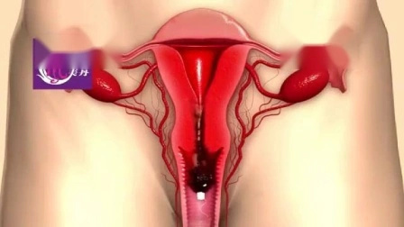 Tampão de ponto limpo vaginal para desintoxicação do útero Produto de higiene feminina para mulheres